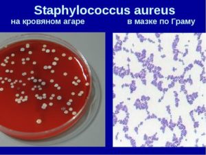 В мазке из зева обнаружили Staphylococcus aureus и Pseudomonas aeruginosa