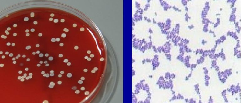 В мазке из зева обнаружили Staphylococcus aureus и Pseudomonas aeruginosa