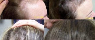 Выпадение волос во время приема Клайры