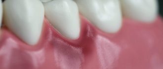 Воспалилась десна