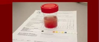 Микрогематурия у ребенка