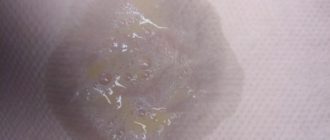 Выделение из носа черного цвета