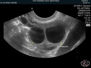 Две кисты на правом яичнике