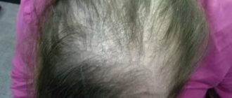 Диагноз дисбактериоз, сильное выпадение волос