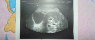 Выделения при хорошем узи. Беременность