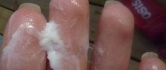 Выделение слизи под крайней плотью