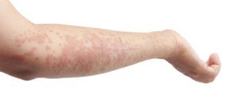 Крапивница на нервной почве