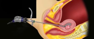 Миома и биопсия
