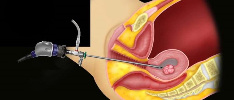 Беременеть после гистероскопии