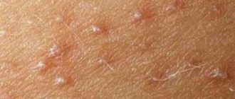 Водянистые прыщи похожи на герпес