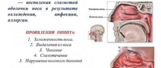 Вазомоторный ринит и головные боли