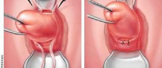 Выделения после наложения шва