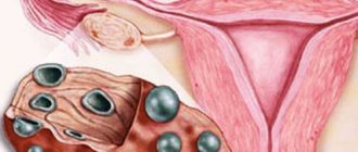 Мелкокистозный яичник