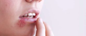 Возможно ли что герпес