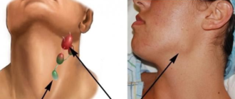 Уже более полугода увеличены лимфоузлы под челюстью, на шее