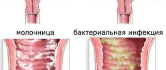 Дисбактериоз и кандидоз