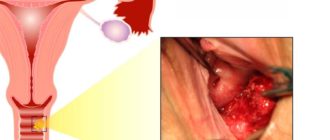 Молочница у девственницы, как лечить