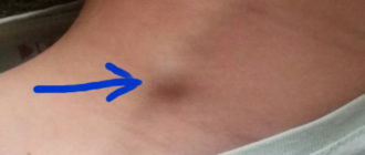 На шее вздулся шарик