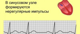 Диагноз синусовая аритмия (107-75)