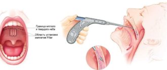 Увеличеные миндалины и храп