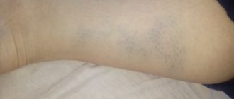 Вены и синяки на ногах