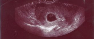 Эмбрион увеличивается в размерах, а сердцебиения нет