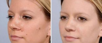 Можно ли удалять родинку на лице в 14 лет?