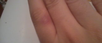 На пальце появился синяк