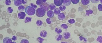 Эозинофилы 13%