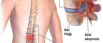 Дискоз поясничного отдела позвоночника, ноет поясница, помогите разобраться