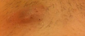 Красная и твердая шишка на лобке