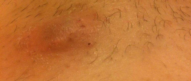 Красная и твердая шишка на лобке