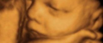 Узи в 36 недель. Диагноз микроцефалия или ЗВРП