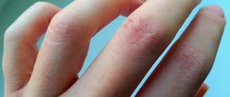 На сгибах пальцев рук огрубевшая кожа шелушится и лопается