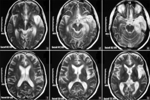 Дисциркуляторная энцефалопатия на МРТ головного мозга