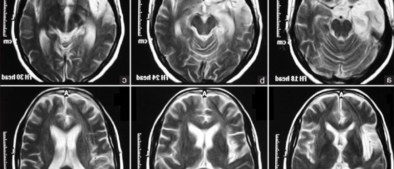 Дисциркуляторная энцефалопатия на МРТ головного мозга