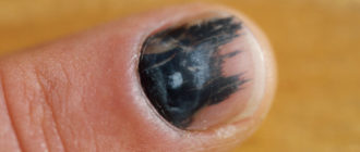 Черный ноготь. После удара