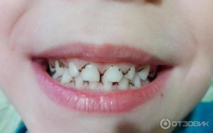 Черный налет на зубах подростка