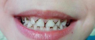 Черный налет на зубах подростка