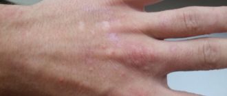 Водяные прыщи на руке и лице