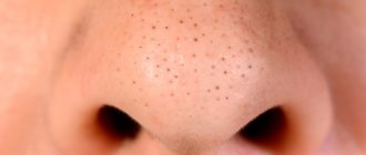 Много черных точек на носу
