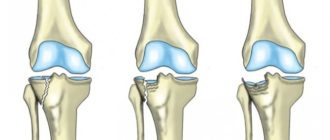 Время лечения перелом медиального мыщелка большеберцовой кости