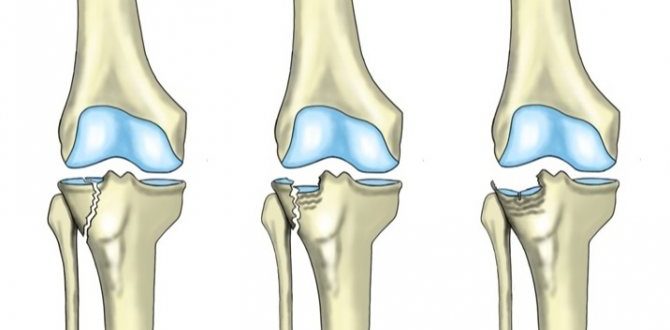 Время лечения перелом медиального мыщелка большеберцовой кости