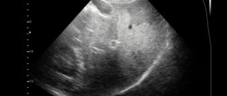 УЗИ печени, жировой гепатоз