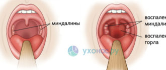 Можно ли гулять при ангине?