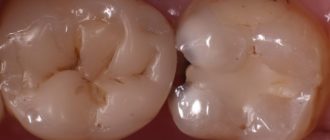 На зубе маленькая дырочка