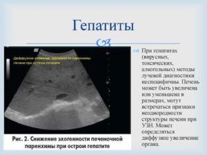 Узи брюшной полости из за гепатита с