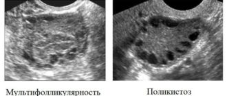Мультифолликулярные изменения яичников