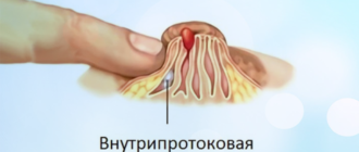 Внутрипротоковая папиллома. Как вылечить?