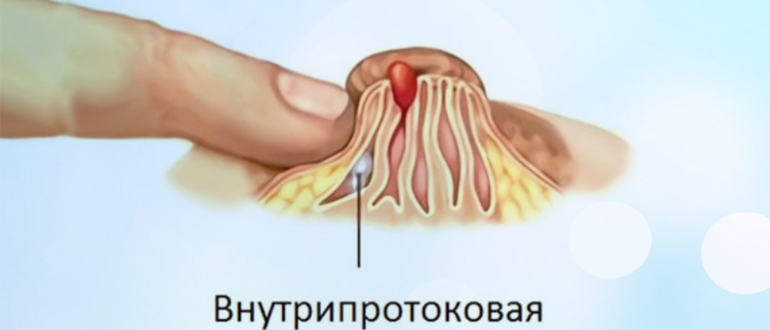 Внутрипротоковая папиллома. Как вылечить?